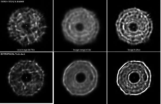 intra et extrafocal du 625 mm
