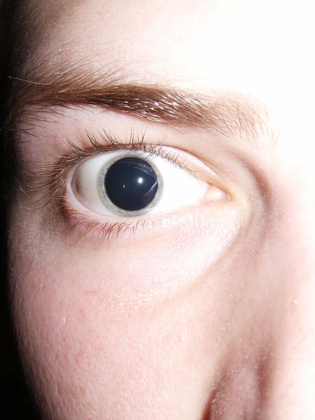 450px-Dilated_pupils_2006.jpg